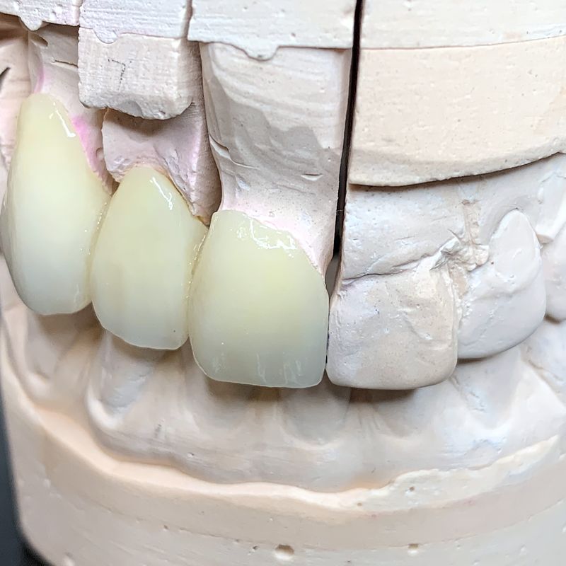 Ceramic crown and bridge on a stone model