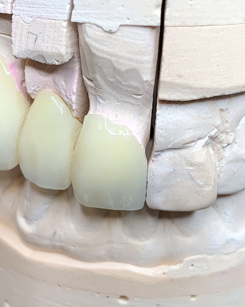 Ceramic crown and bridge restorations on a stone model