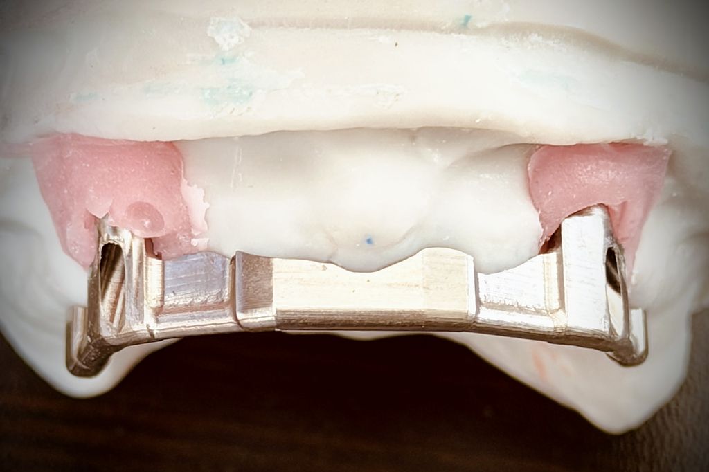 Hader bar on a full-arch stone model
