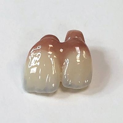 Two implant crowns with pink gingival ceramic