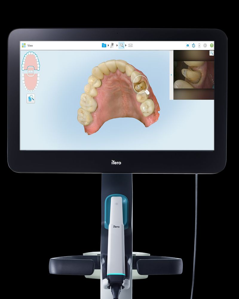 iTero intraoral scanner on its cart, the screen showing a full-arch 3D scan