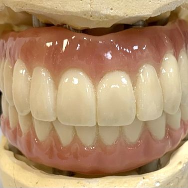 Mounted All-on-X prosthesis on an articulated model