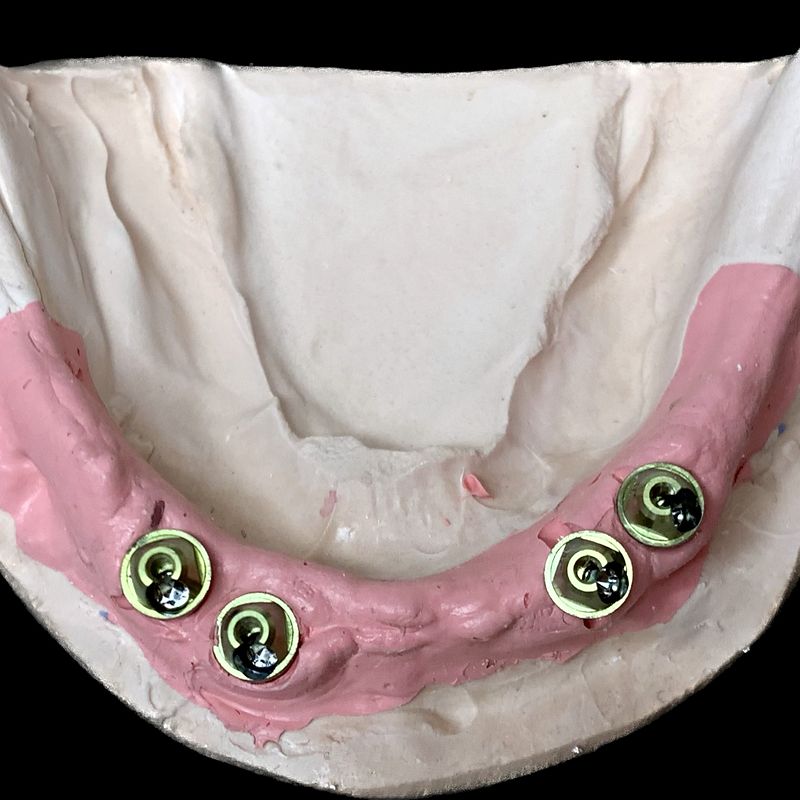 Lower stone model with four multi-unit abutment analogs set in pink soft-tissue material