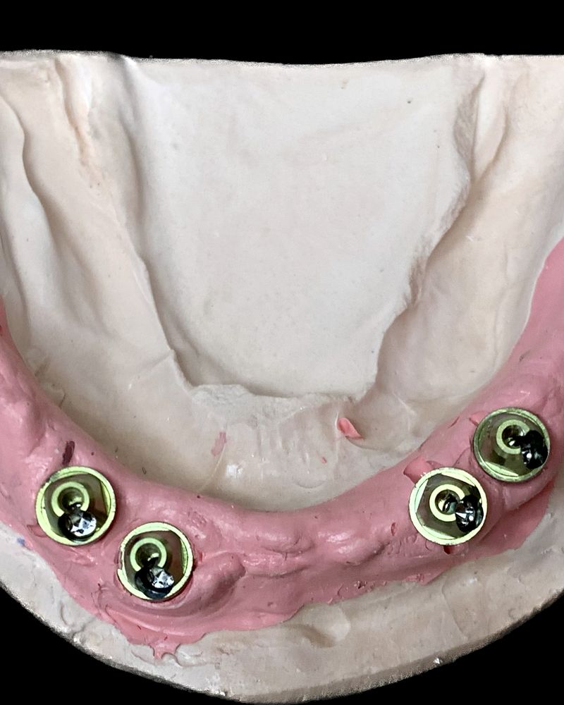 Full-arch stone model with multi-unit abutments for an All-on-X case