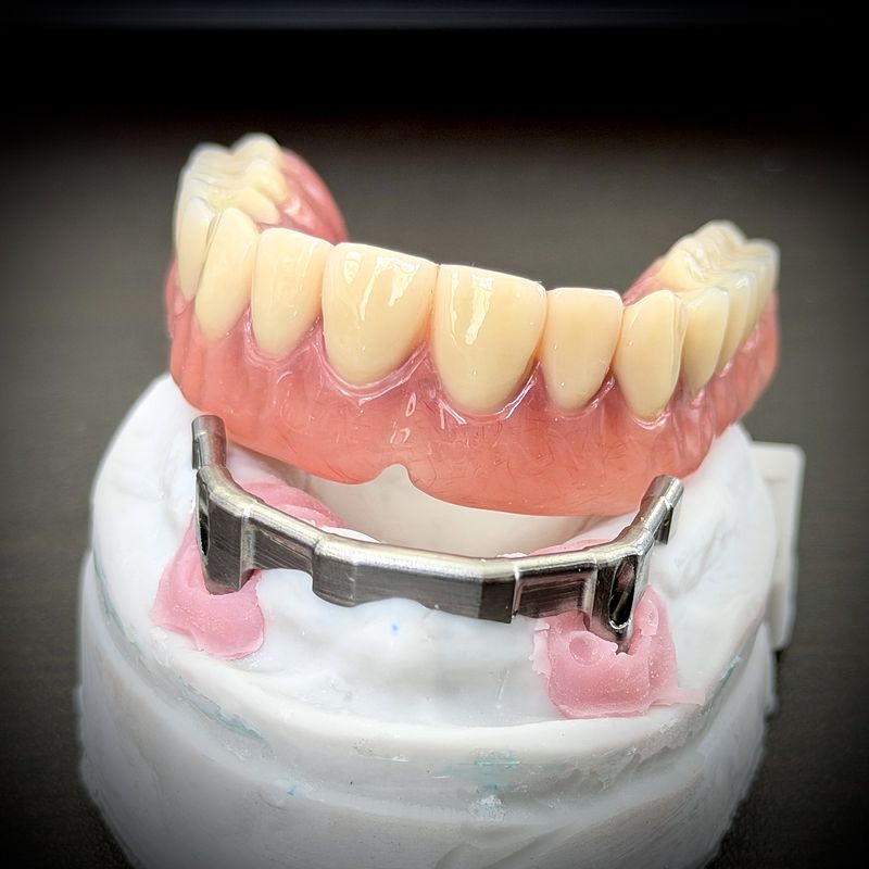 Implant overdenture seated on a bar