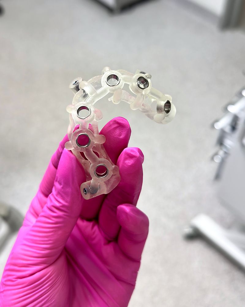 3D-printed full-arch implant surgical guide with metal drill sleeves, held in a gloved hand