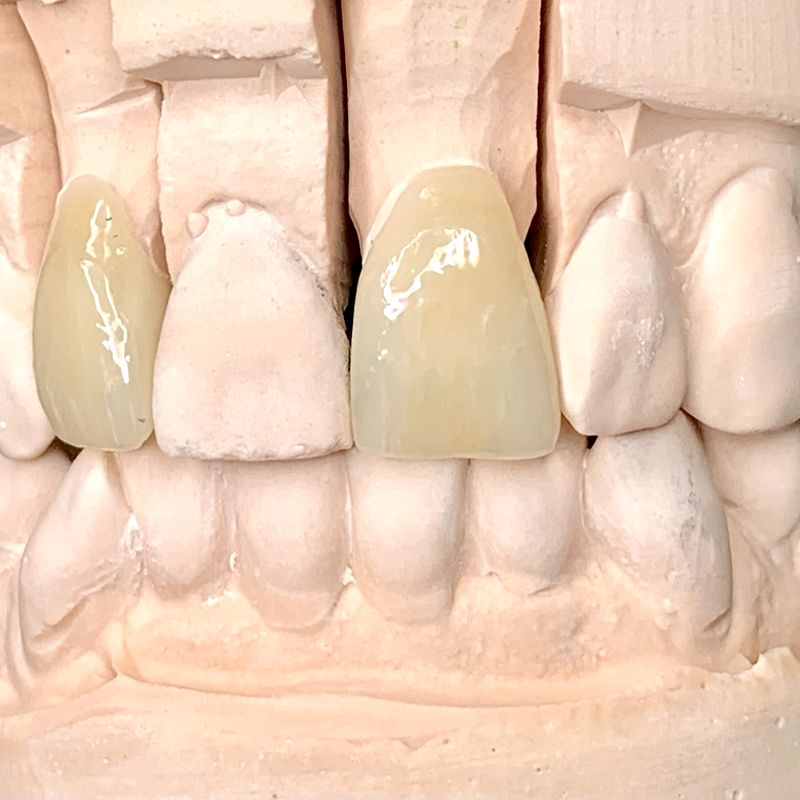 Anterior ceramic restorations on a sectioned stone model