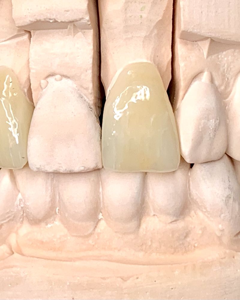 Anterior ceramic veneers on a sectioned stone model