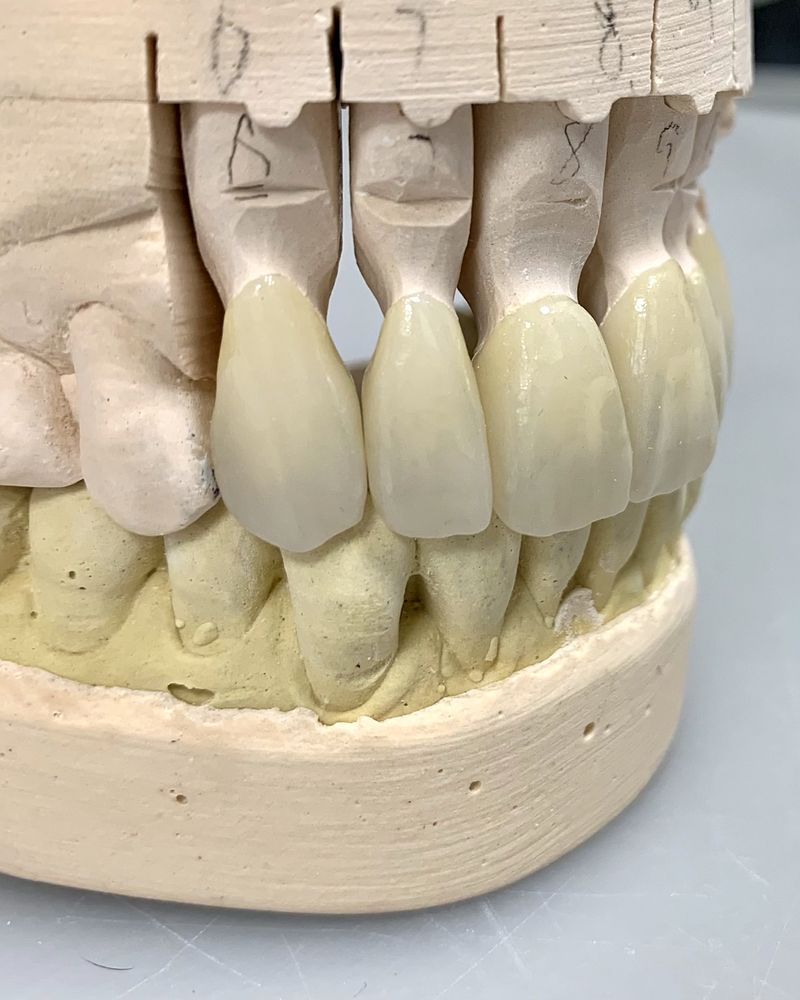 Two esthetic zirconia crowns on a stone model